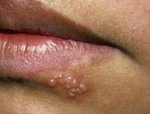 natural-remedies-for-herpes-simplex