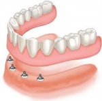 dental-implants-albany