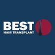 best-hair-transplant